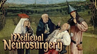 Middle Ages Surgery History of Neurosurgery [upl. by Idnek43]