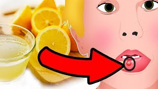 Natural Cures for Mucocele Mucous Cyst  How I treat it [upl. by Gerti]