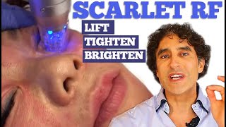 SCARLET RF  Non Surgical Face Treatment [upl. by Rundgren391]