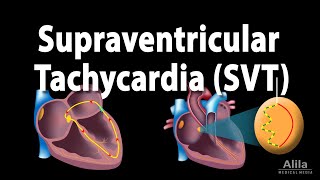 Supraventricular Tachycardia SVT PSVT Animation [upl. by Weiman]