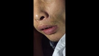 Orofacial Dyskinesia [upl. by Anatsirhc]